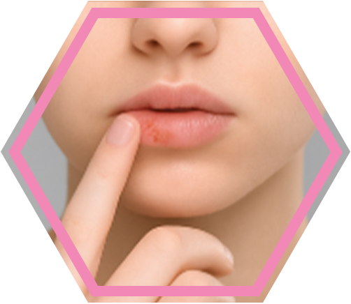 Afinovir_Herpes-Stadien_2