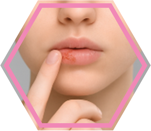 Afinovir_Herpes-Stadien_3