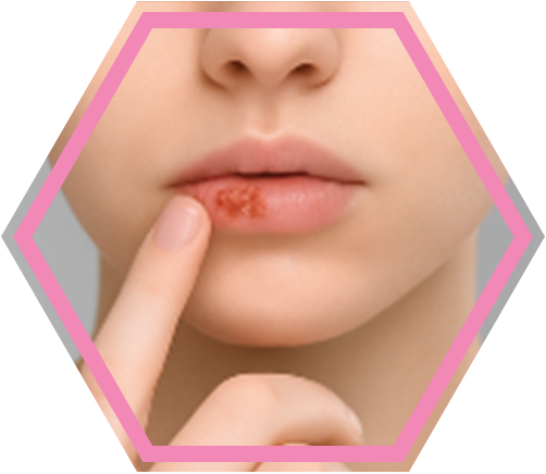 Afinovir_Herpes-Stadien_4